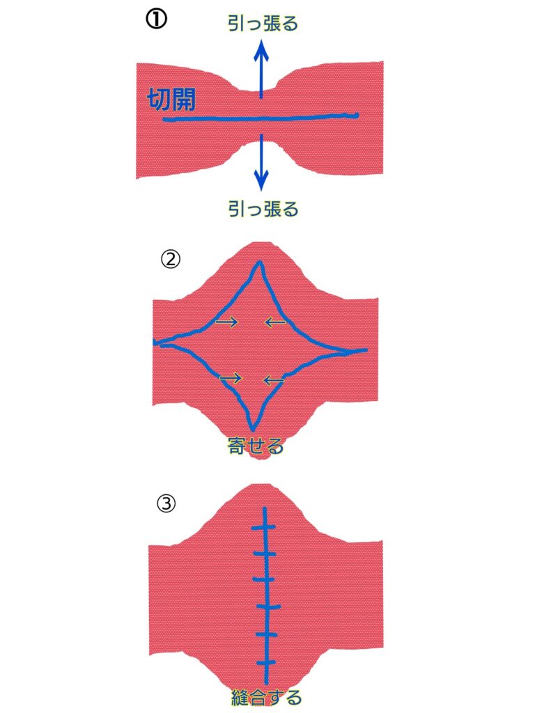 狭窄形成術の術式イメージ画像 狭窄形成術の術式イメージ画像