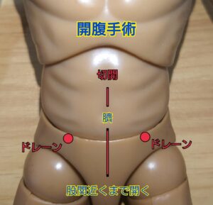 開腹手術の切開範囲とドレーン挿入場所のイメージ画像