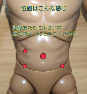 腹腔鏡下による術式のスコープ挿入と切開場所のイメージ画像