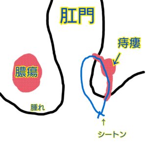 クローン病の痔瘻に対する治療・シートン留置術の手書きイラスト