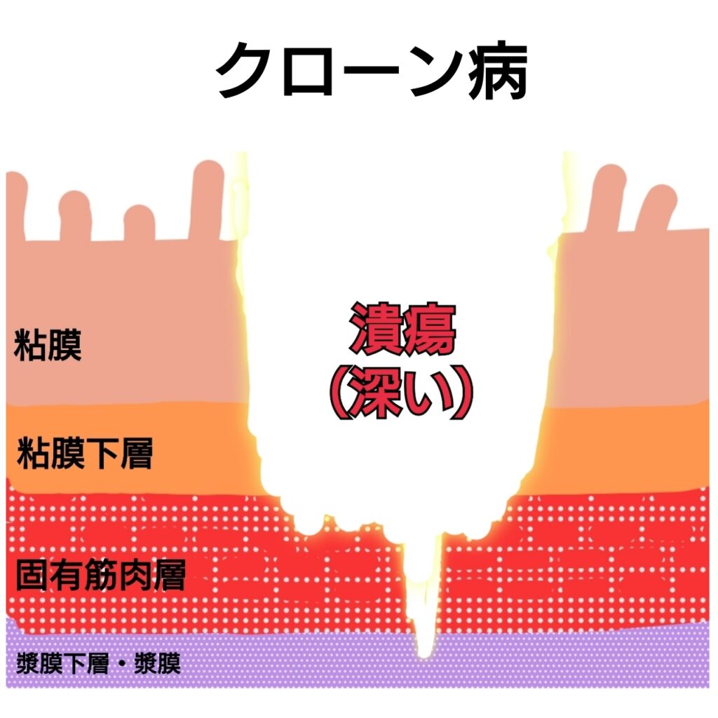 クローン病の潰瘍の深さの断面イラスト図解