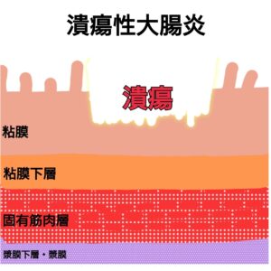 潰瘍性大腸炎の潰瘍の深さ・断面イラスト図解