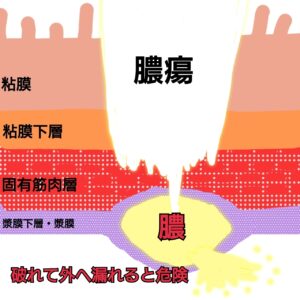 クローン病の膿瘍のイラスト図解