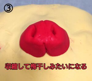 粘土模型による人工肛門形成のプロセスイメージ③