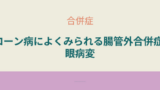 クローン病の腸管外合併症としての眼病変。ぶどう膜炎や結膜炎など目の症状