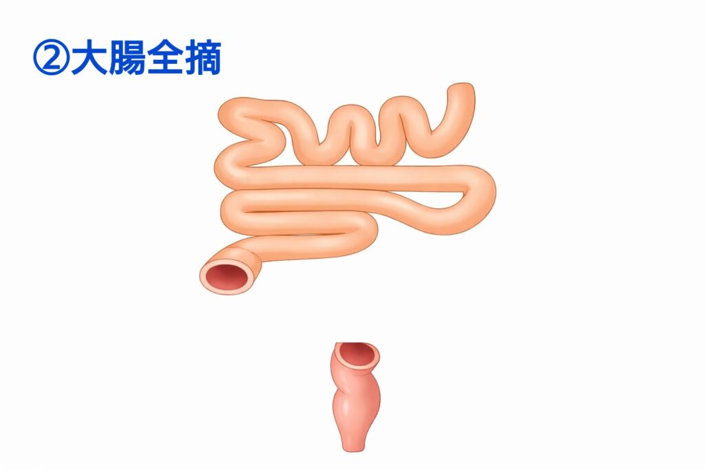 大腸を全摘した後の小腸と直腸を示した模式図