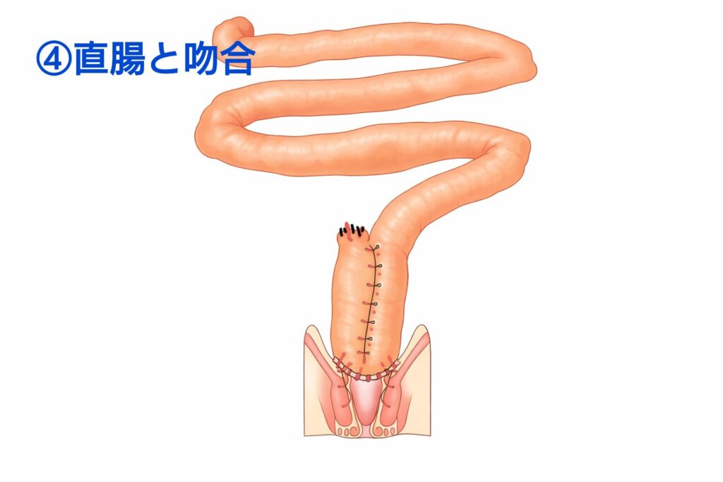 作成した回腸嚢を直腸と吻合した状態を示す模式図